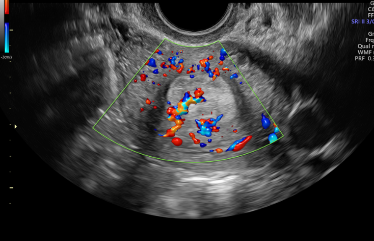 Ultrasound & Colour Doppler